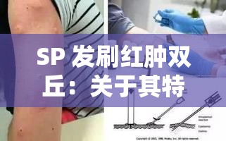 SP 发刷红肿双丘：关于其特点与相关情况的探讨